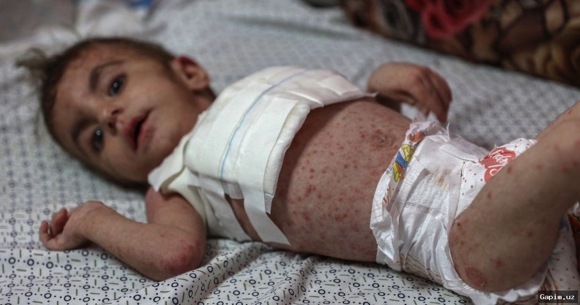 🏥⚠️ В Газе распространяются кожные заболевания: ООН требует экстренных мер