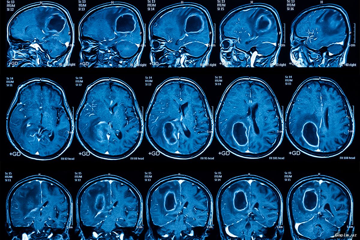 🧠💉 Новая вакцина против опухолей мозга: результаты исследования вселяют надежду